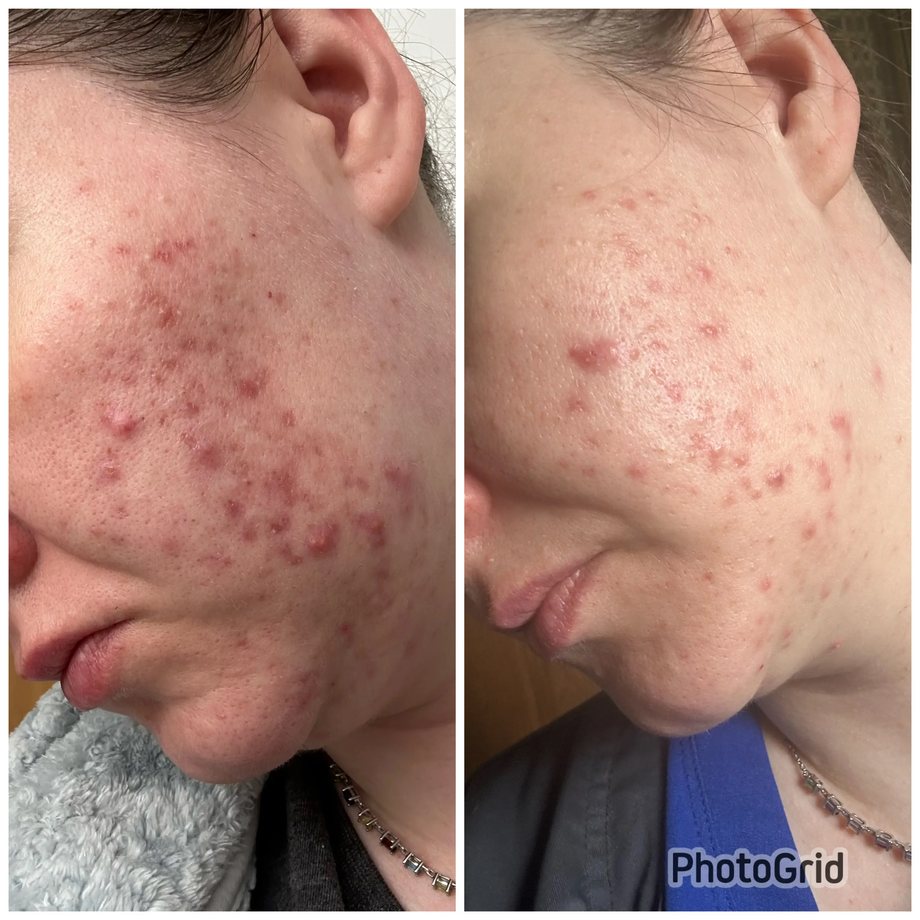Acne Boot-Camp