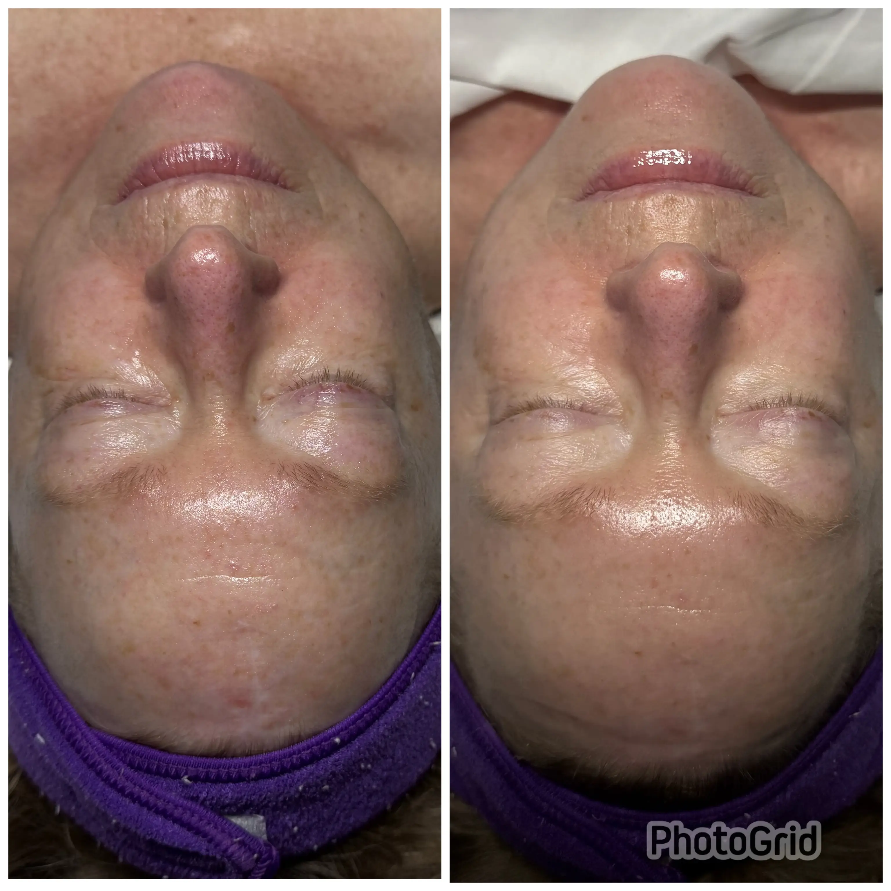 Luxe Lift (Anti-aging)