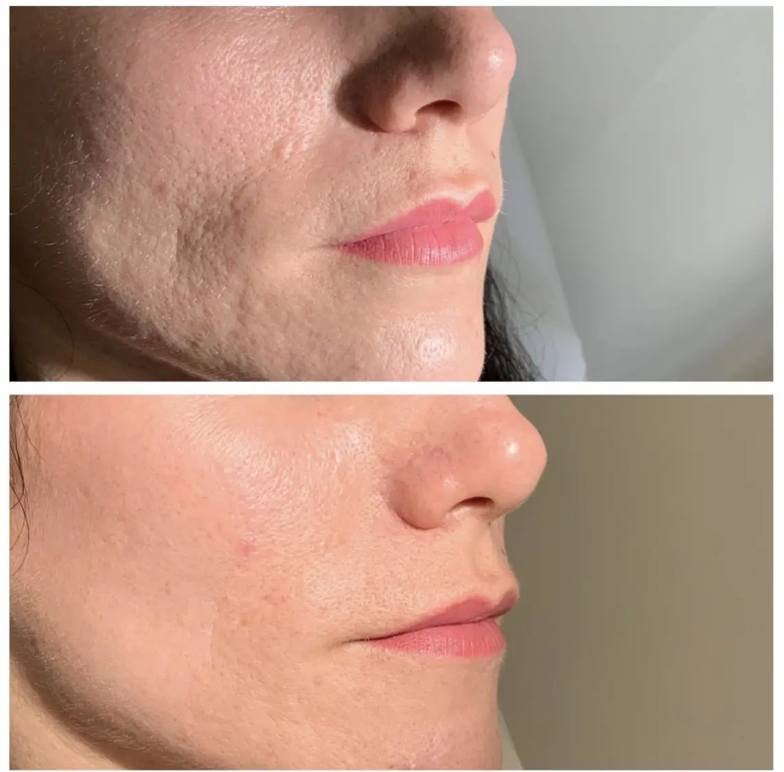 5 Months Treatment 