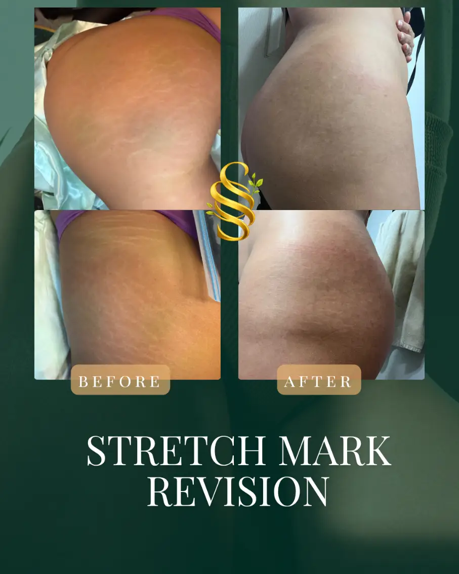 Stretch Mark Camouflage