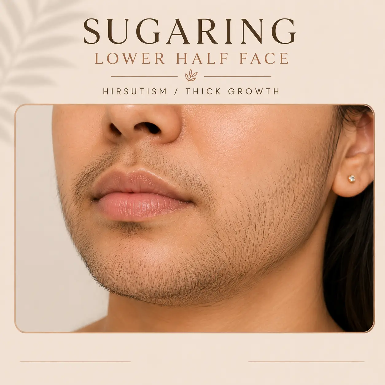 Sugaring-  Lower half Face, (Hirsutism) thick growth