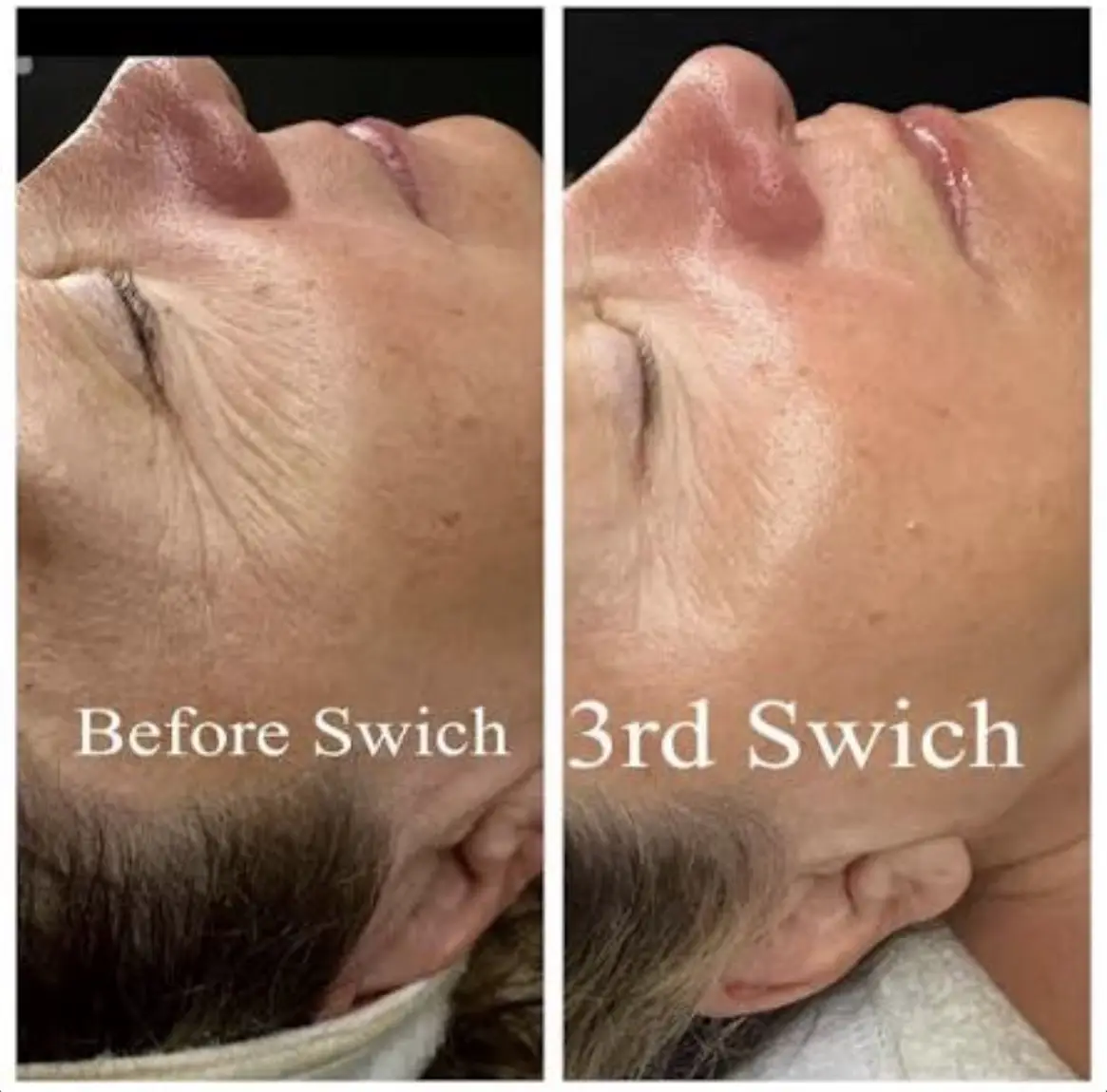 Circadia SWiCH™ Custom Facial