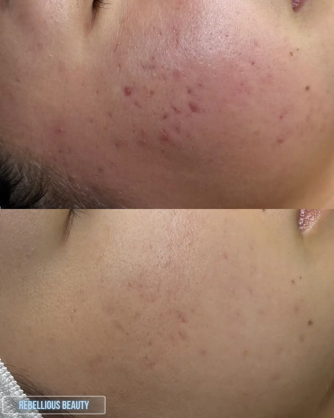 Clear Skin Acne Journey Consultation & Treatment