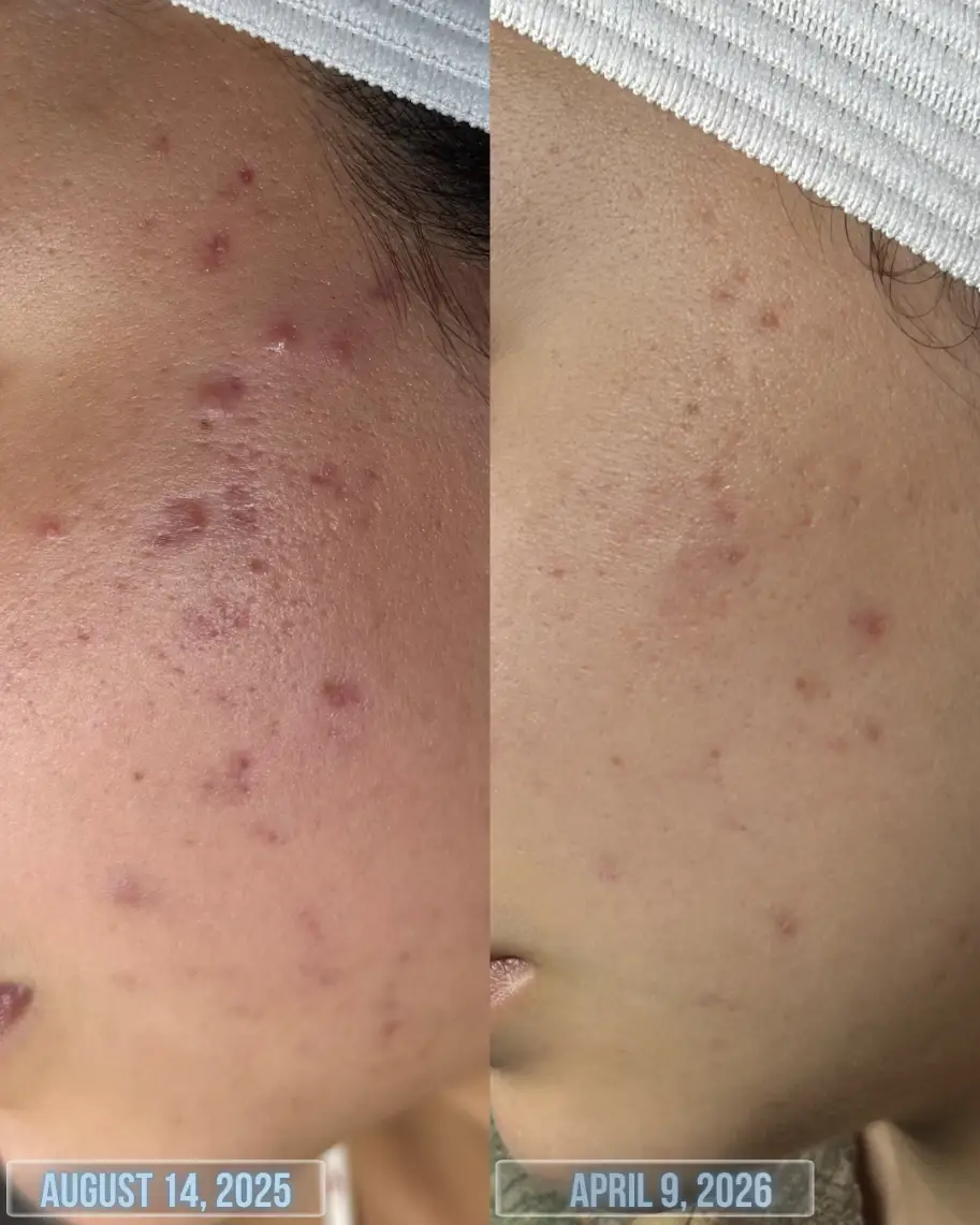 Clear Skin Acne Journey Consultation & Treatment