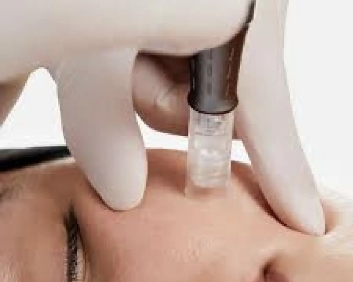 Microneedling 
