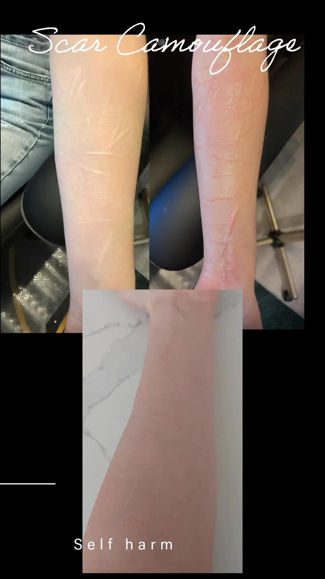 Surgical Scar Camouflage